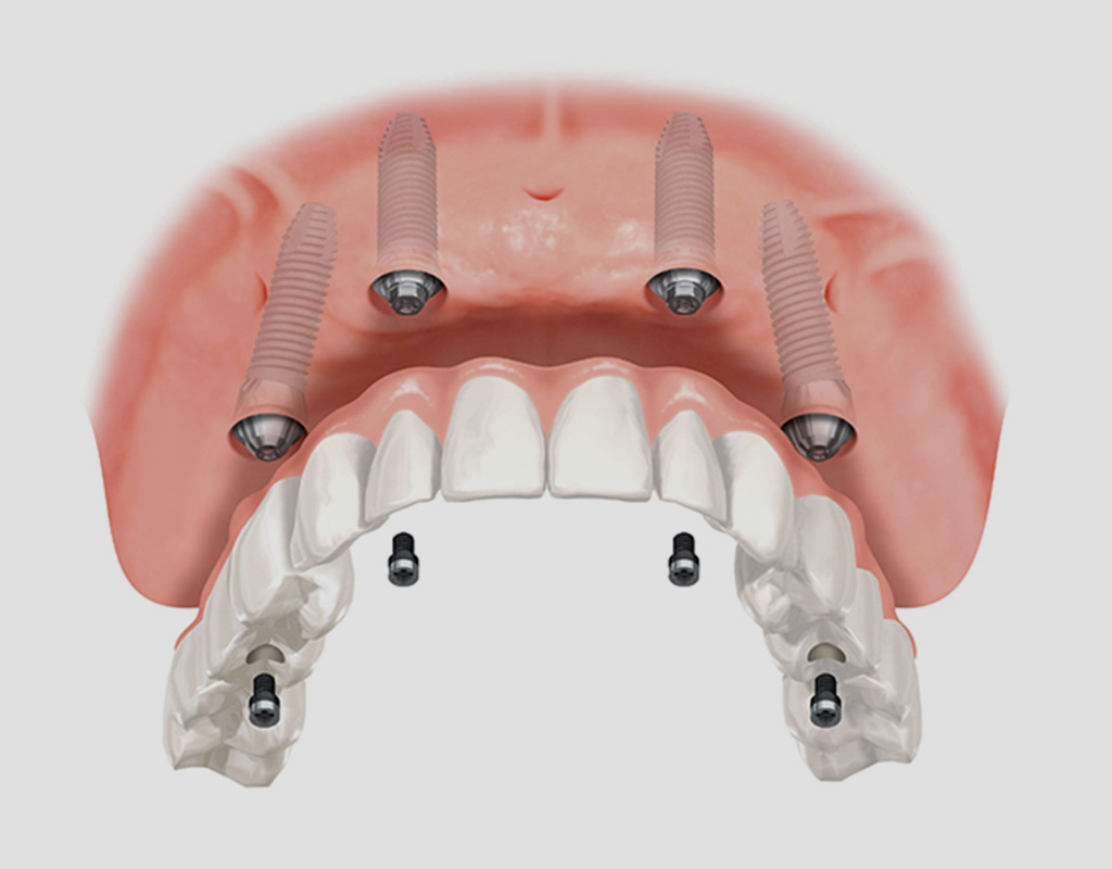 implantes en 1 día Santa Coloma de Gramenet