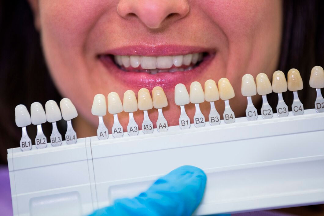 Carillas dentales en Santa Coloma de Gramanet
