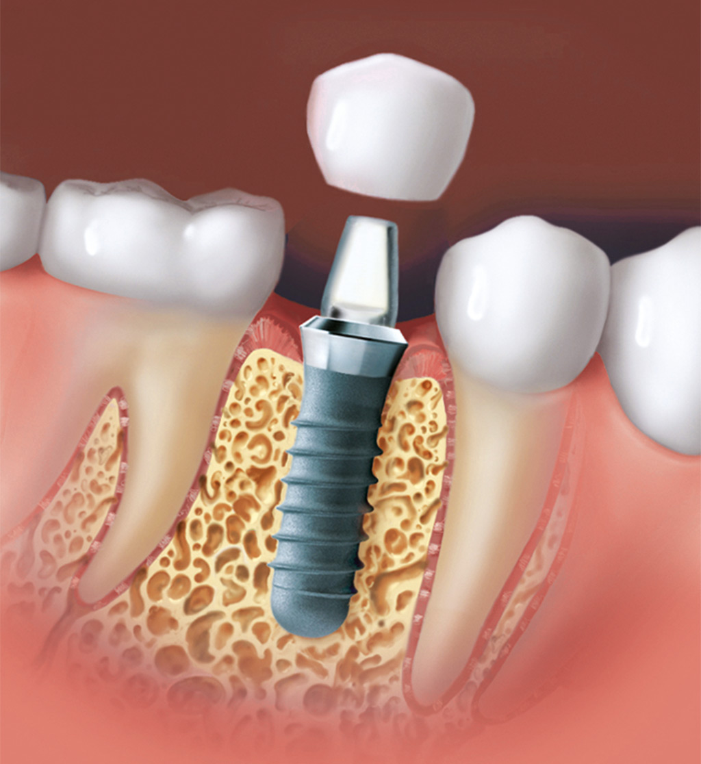 implantes dentales Santa Coloma de Gramenet