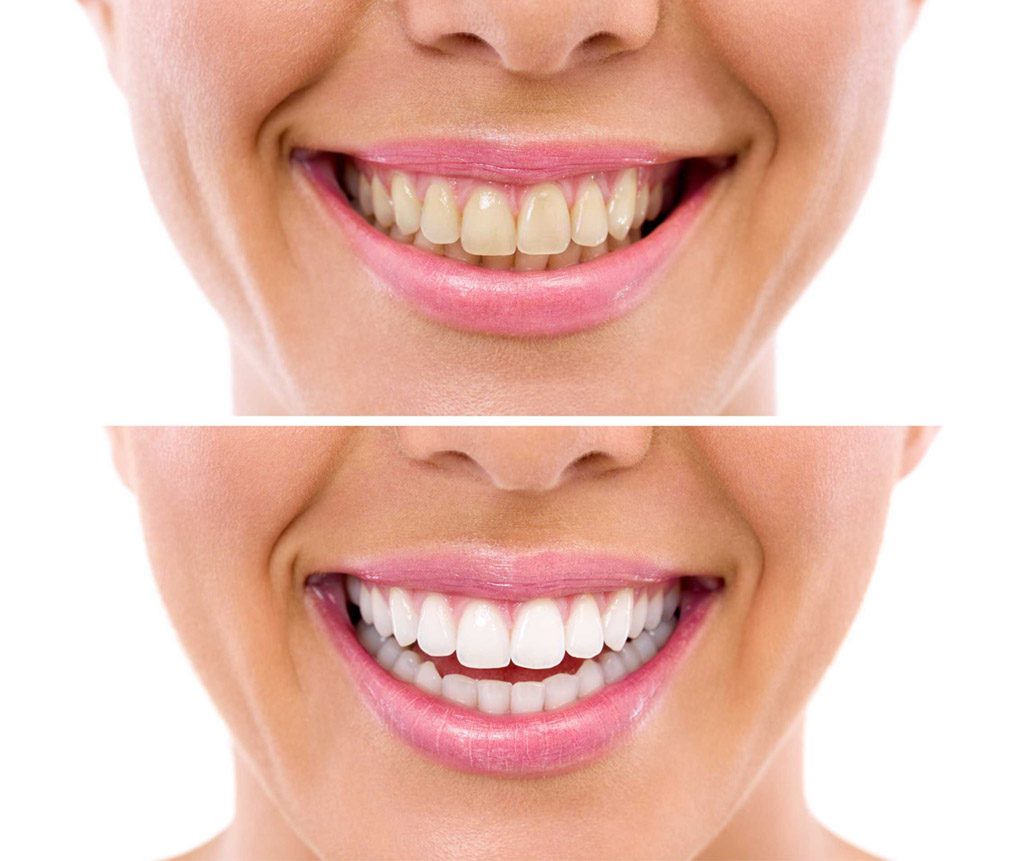 blanqueamiento dental en Santa Coloma de Gramenet