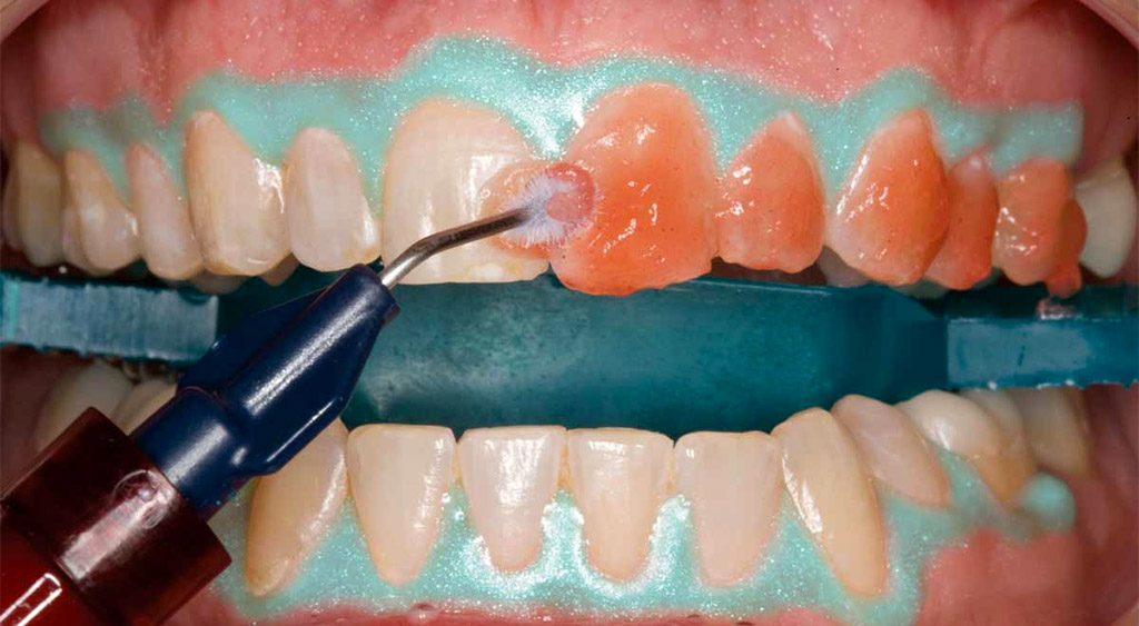 blanqueamiento dental en Santa Coloma de Gramenet