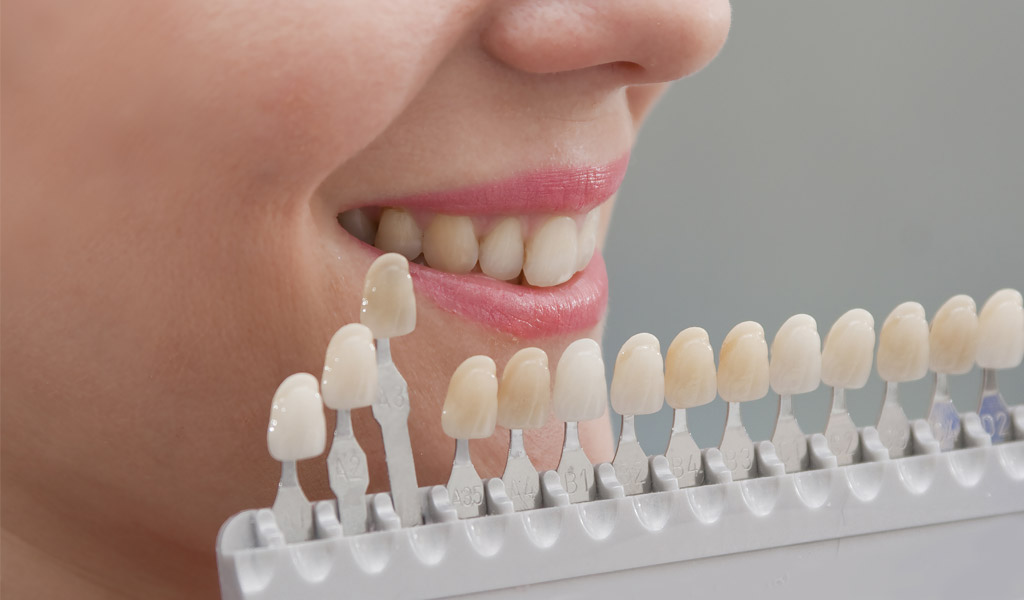 blanqueamiento dental en Santa Coloma de Gramenet