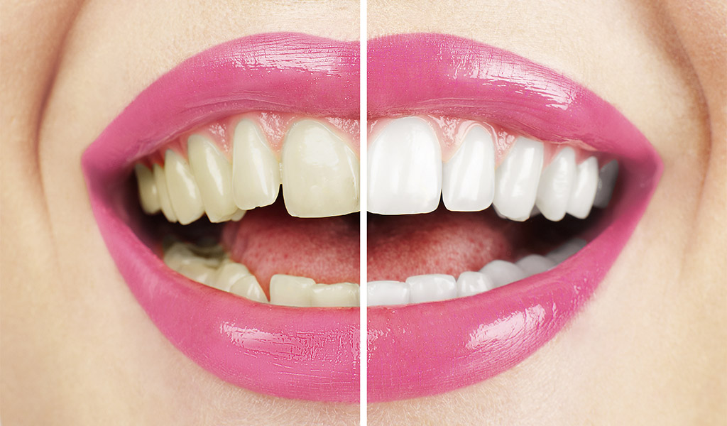 estética dental en Santa Coloma de Gramenet