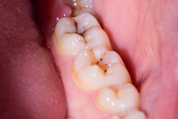 caries