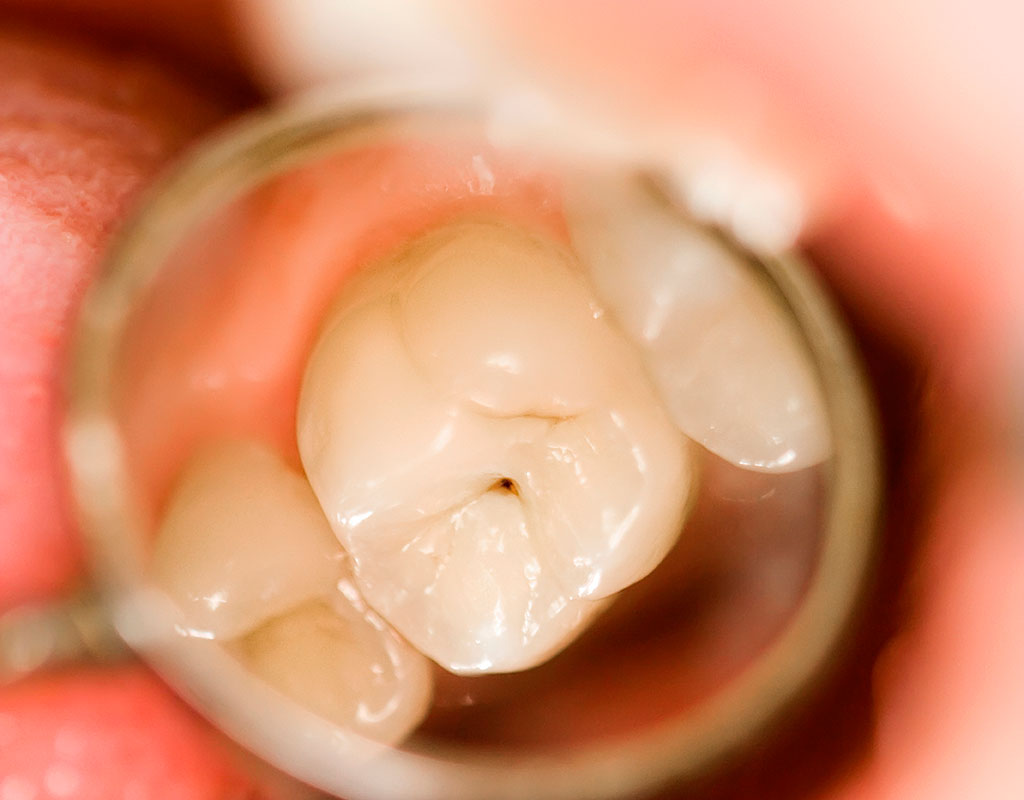 caries y endodoncia en Santa Coloma de Gramenet