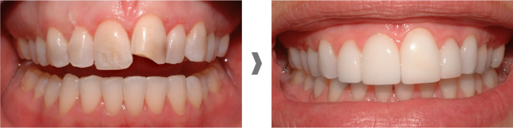 Carillas dentales sin rebajar el diente en Santa Coloma de Gramenet