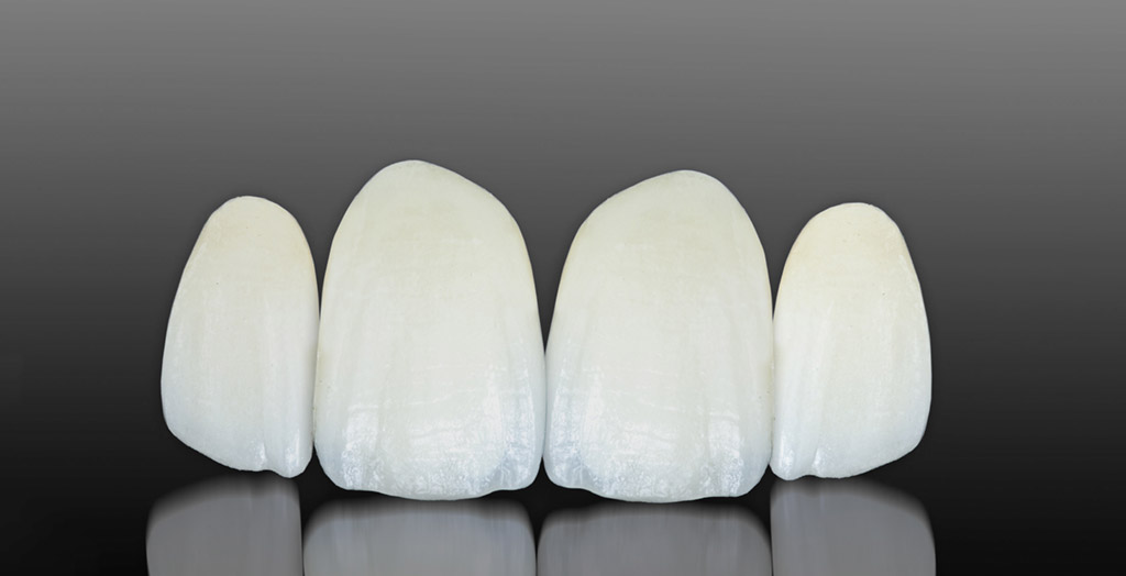 Carillas dentales sin rebajar el diente en Santa Coloma de Gramenet