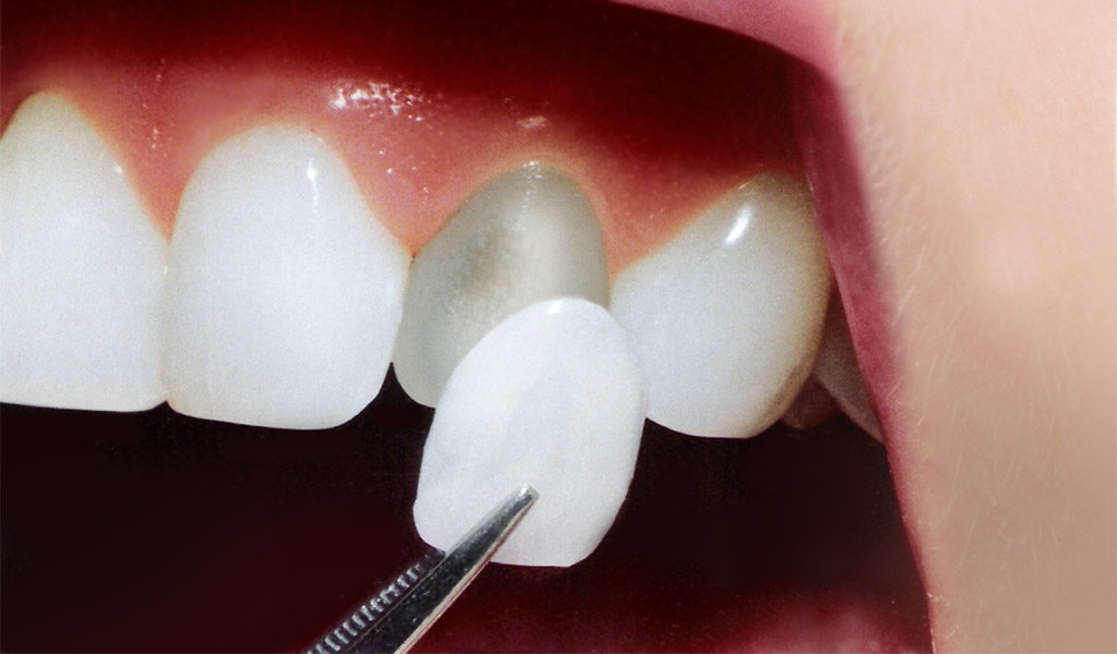 estética dental en Santa Coloma de Gramenet