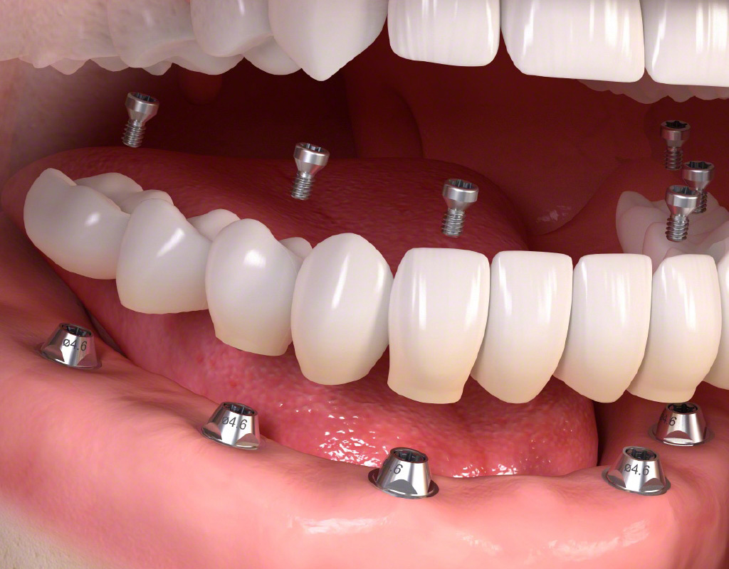 implantes dentales Santa Coloma de Gramenet