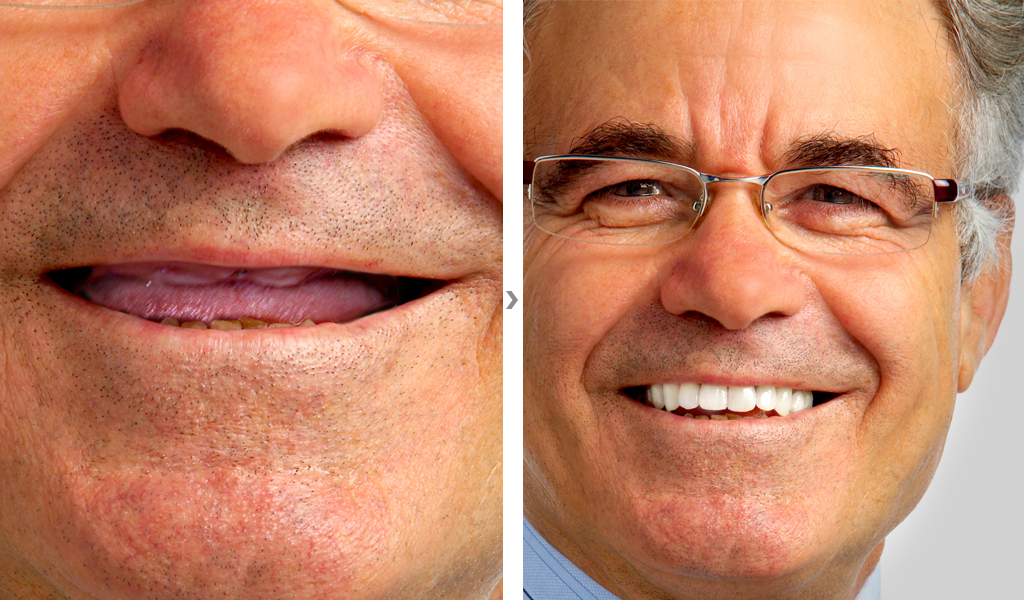 Dentadura fijada con implantes dentales en Santa Coloma de Gramenet