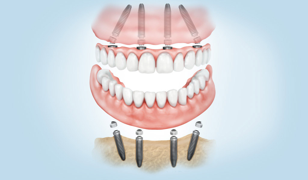 Dentadura fijada con implantes dentales en Santa Coloma de Gramenet