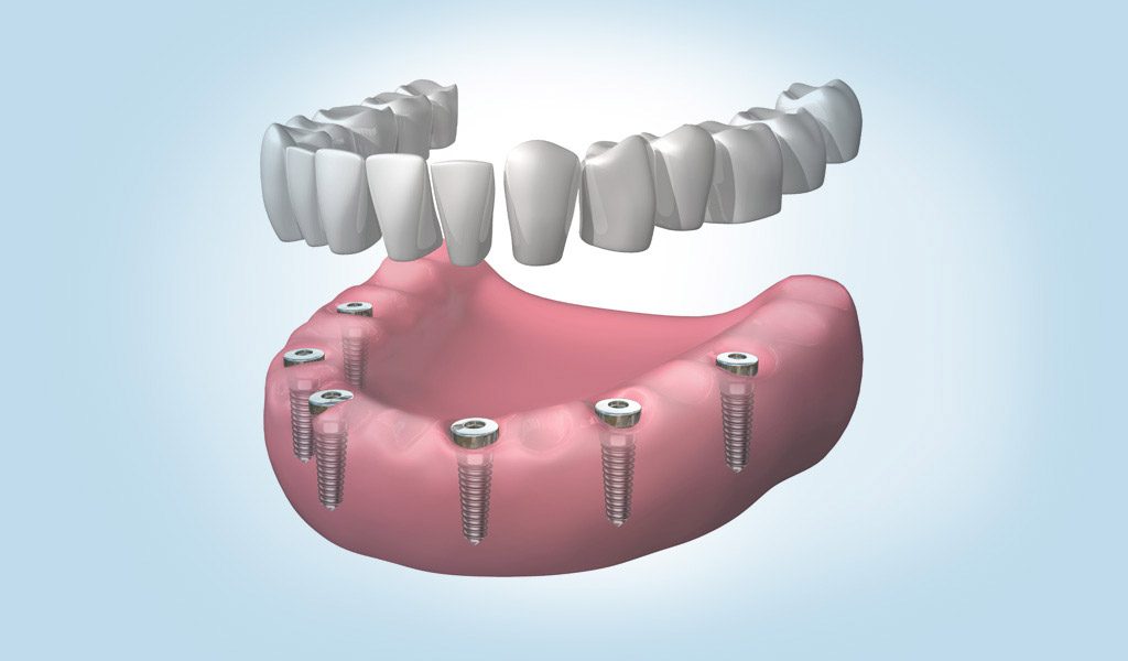 Dentadura fijada con implantes dentales en Santa Coloma de Gramenet