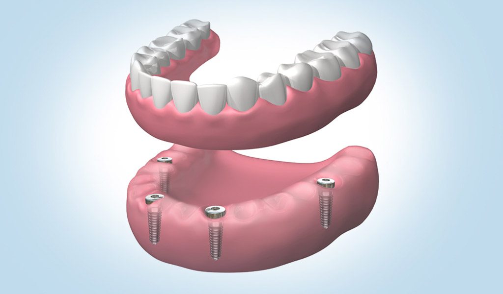 Dentadura fijada con implantes dentales en Santa Coloma de Gramenet