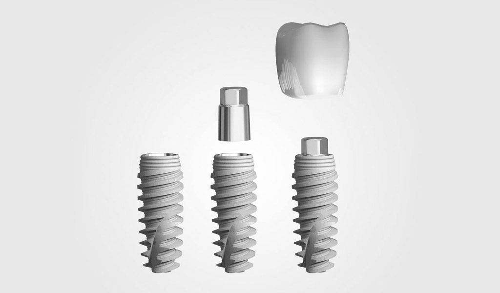Dentadura fijada con implantes dentales en Santa Coloma de Gramenet