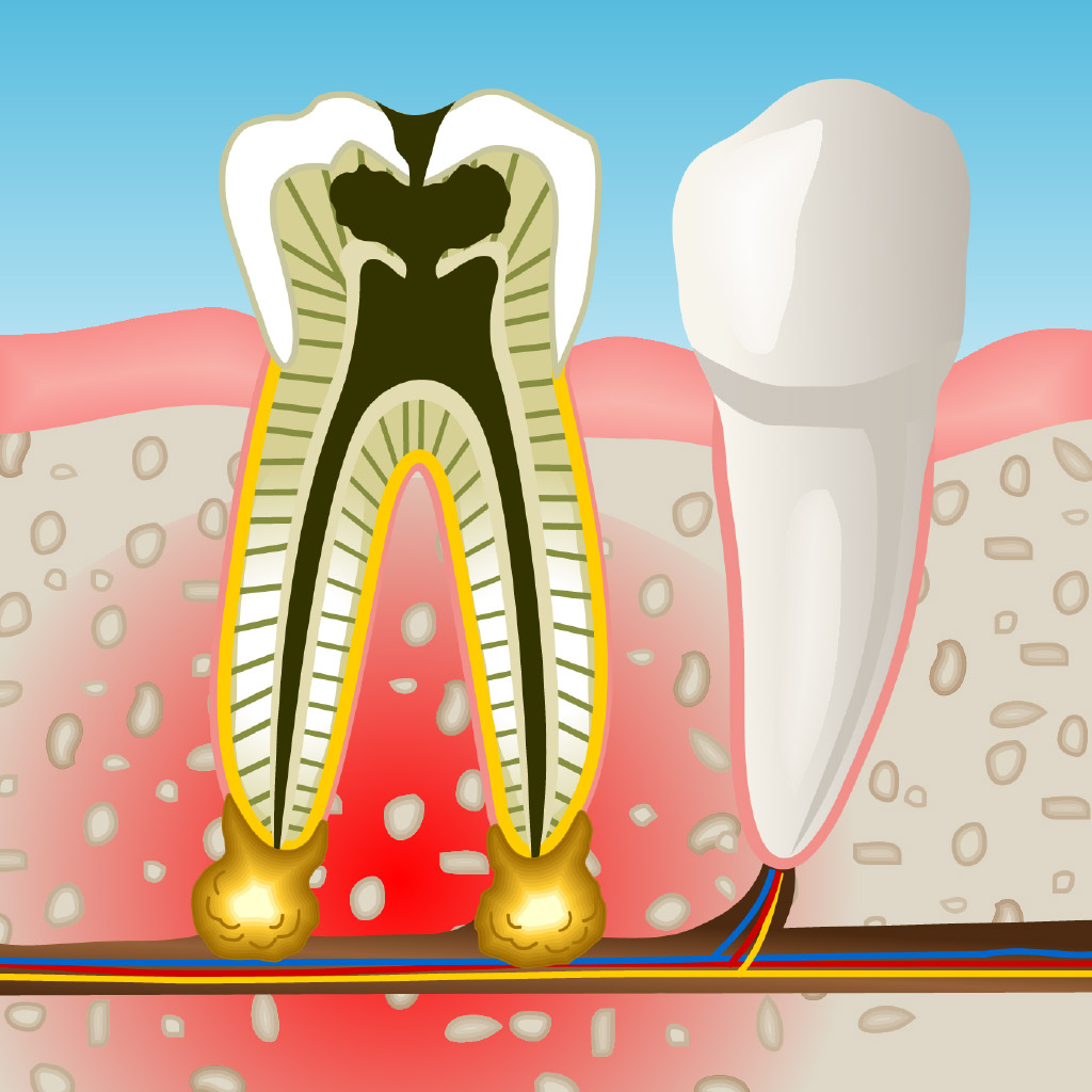 endodoncia en Santa Coloma de Gramenet