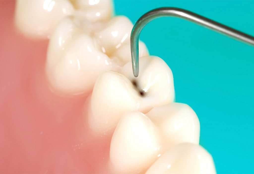 endodoncia en Santa Coloma de Gramenet