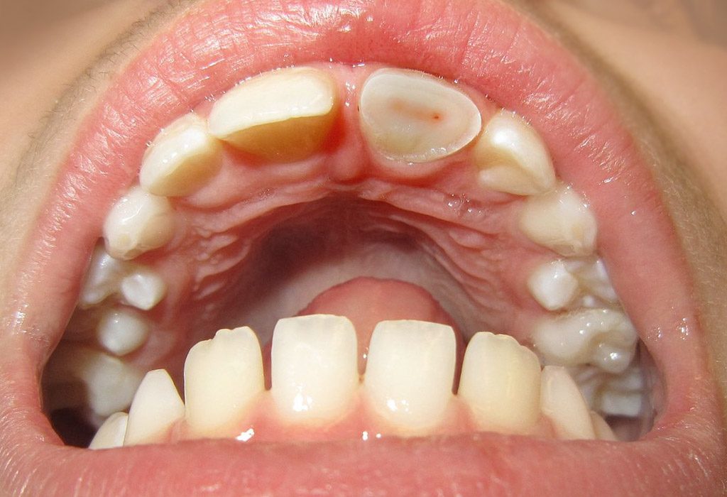 endodoncia en Santa Coloma de Gramenet