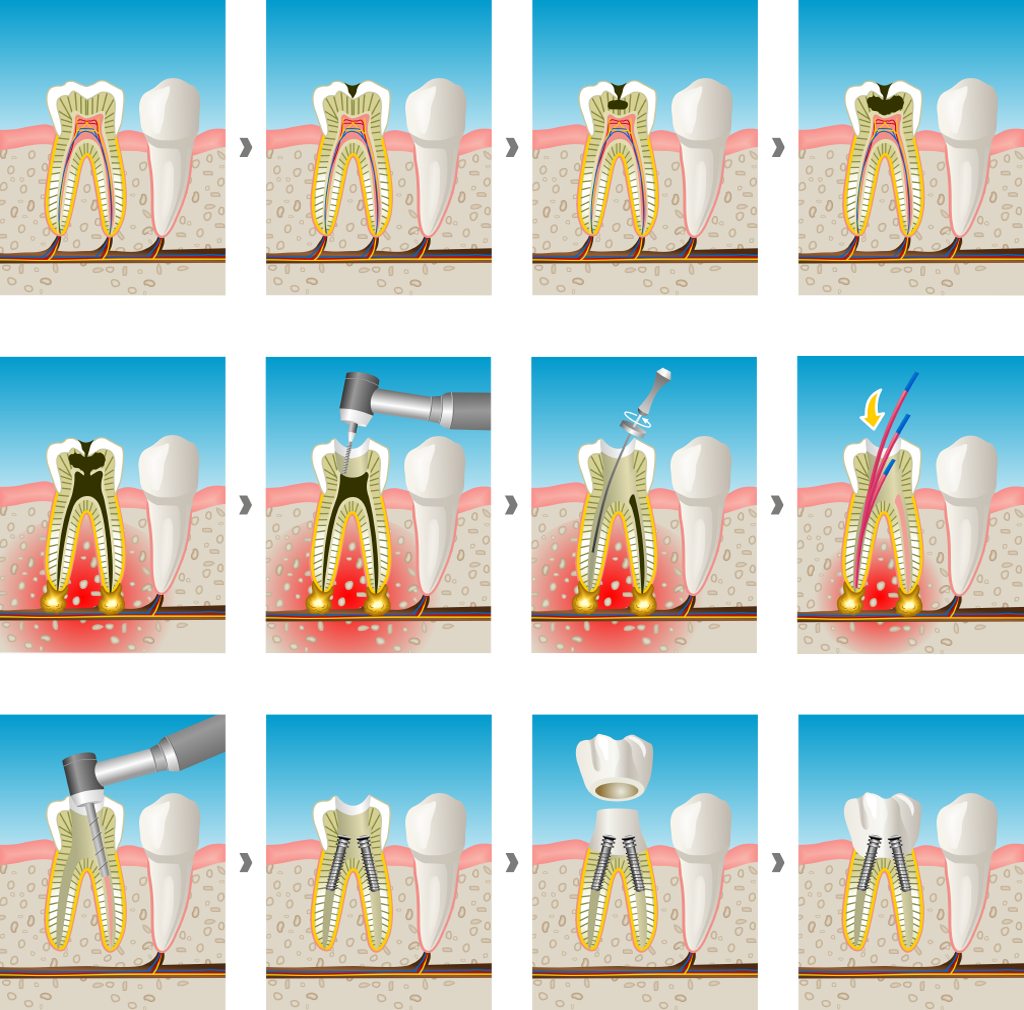 caries y endodoncia en Santa Coloma de Gramenet