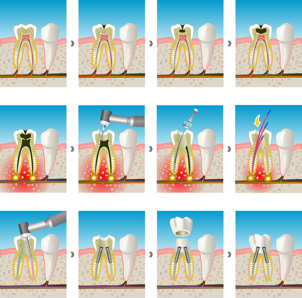 endodoncia en Santa Coloma de Gramenet