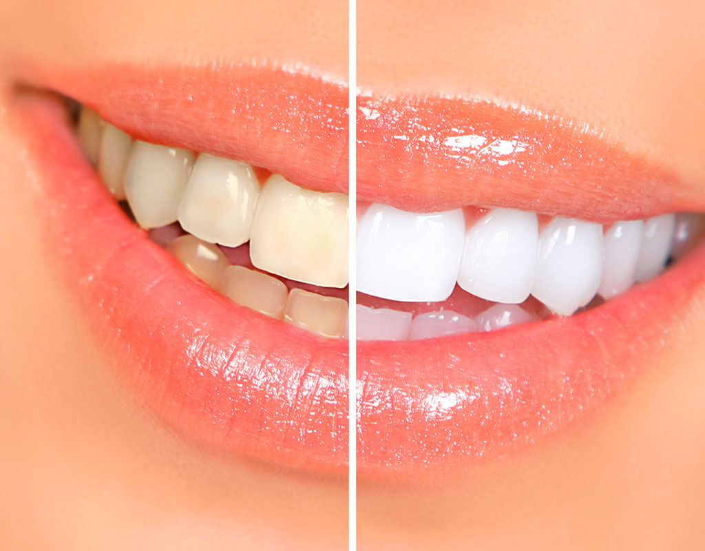 estética dental en Santa Coloma de Gramenet