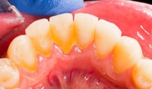 higiene dental en Santa Coloma de Gramenet