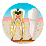 caries y endodoncia en Santa Coloma de Gramenet