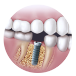 implantes dentales Santa Coloma de Gramenet