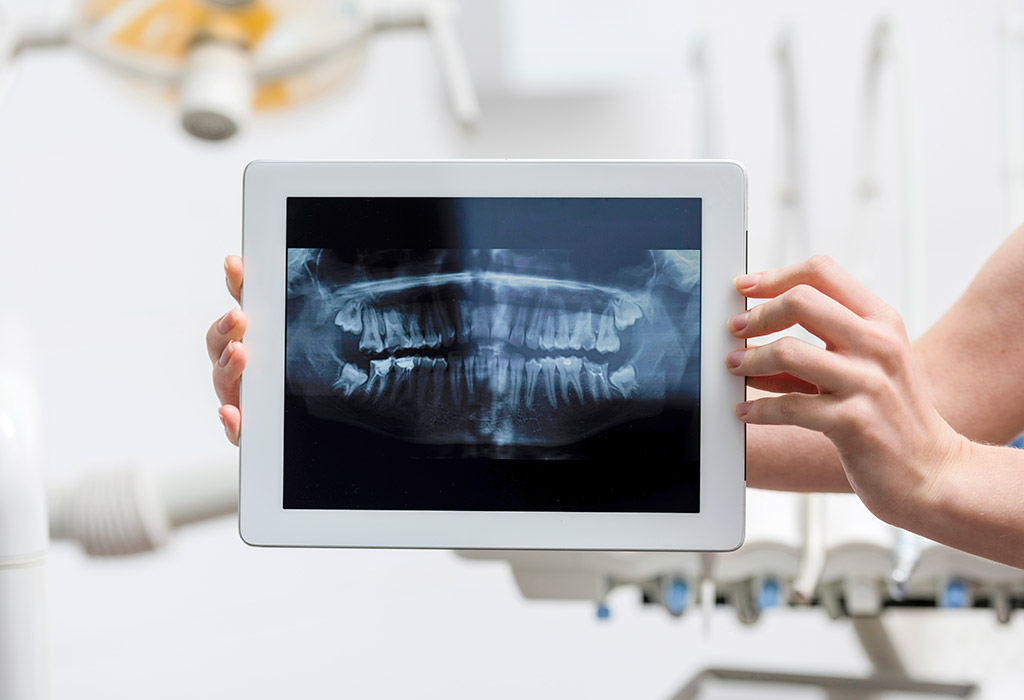 Implantes dentales de carga inmediata en Santa Coloma de Gramenet