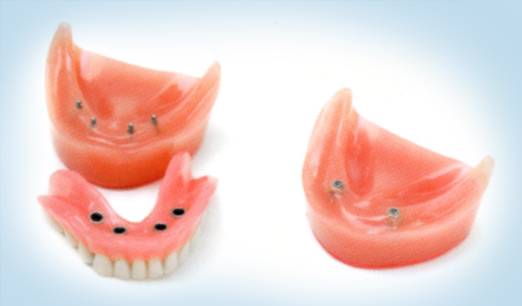 implantes dentales Santa Coloma de Gramenet