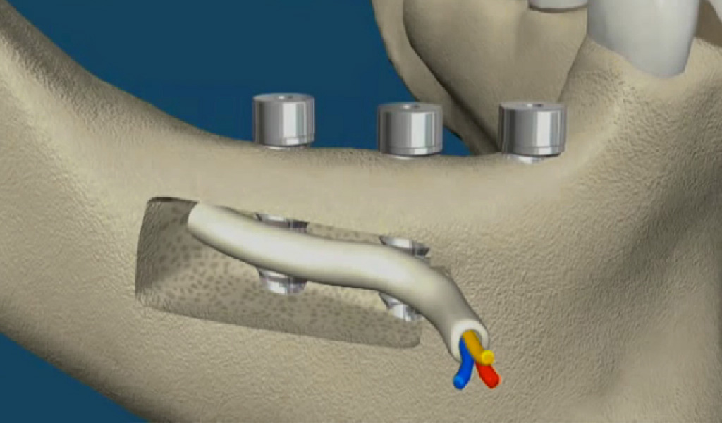implantes dentales Santa Coloma de Gramenet