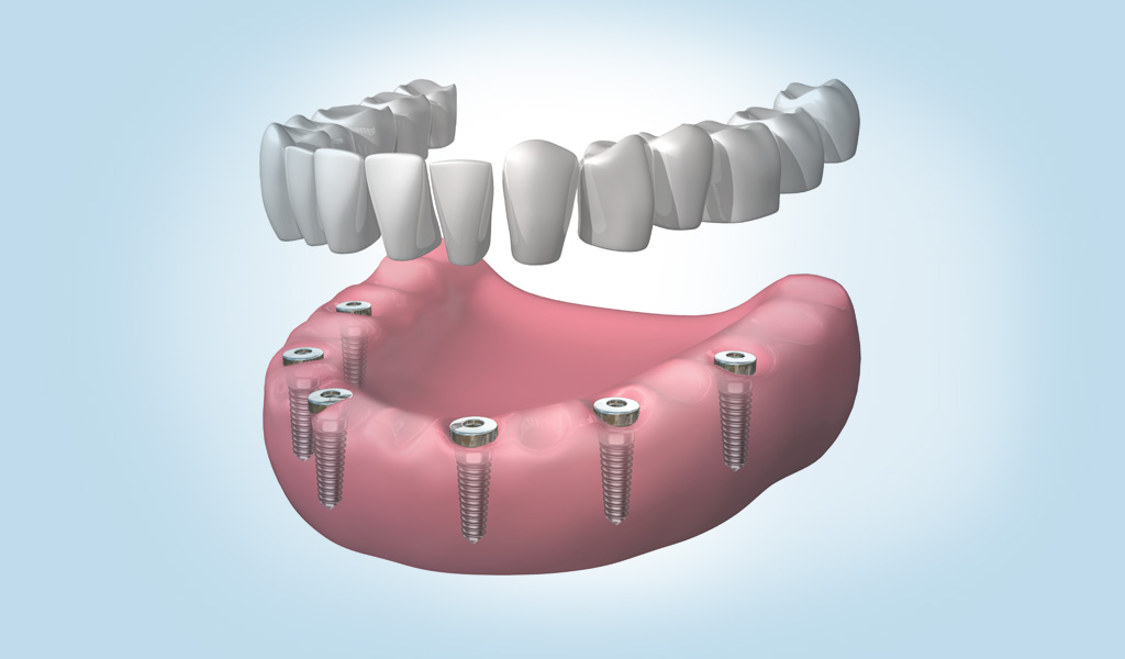 implantes dentales Santa Coloma de Gramenet