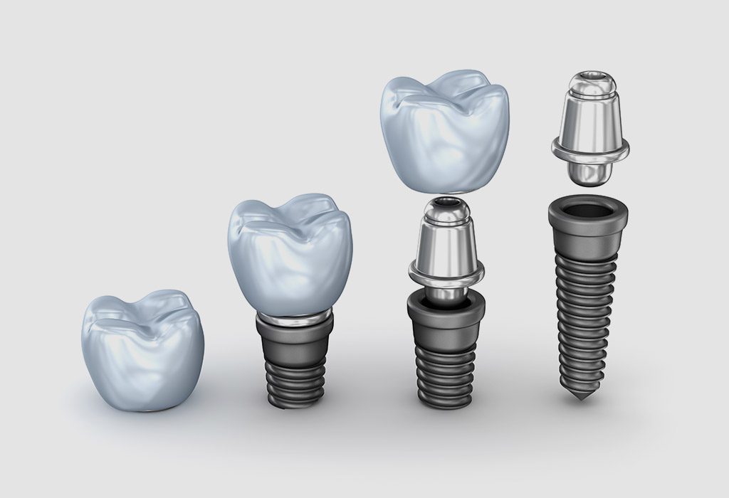 Implantología dental en Santa Coloma de Gramenet