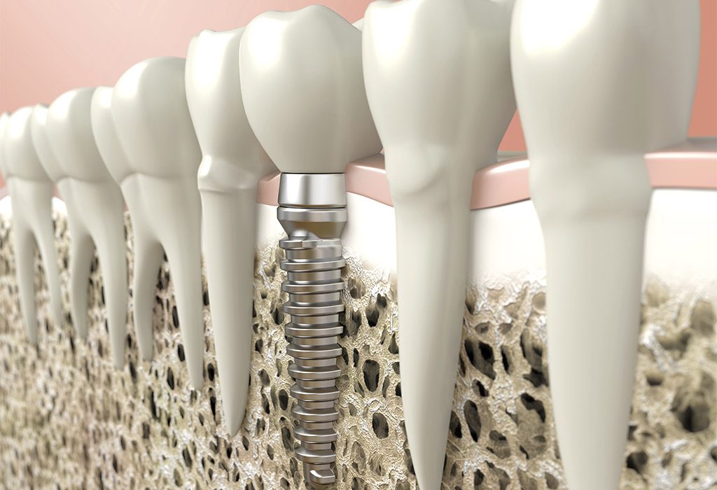 Implantología dental en Santa Coloma de Gramenet