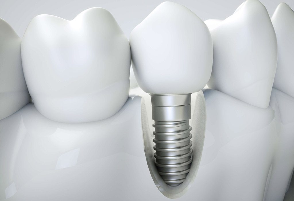 Implantología dental en Santa Coloma de Gramenet
