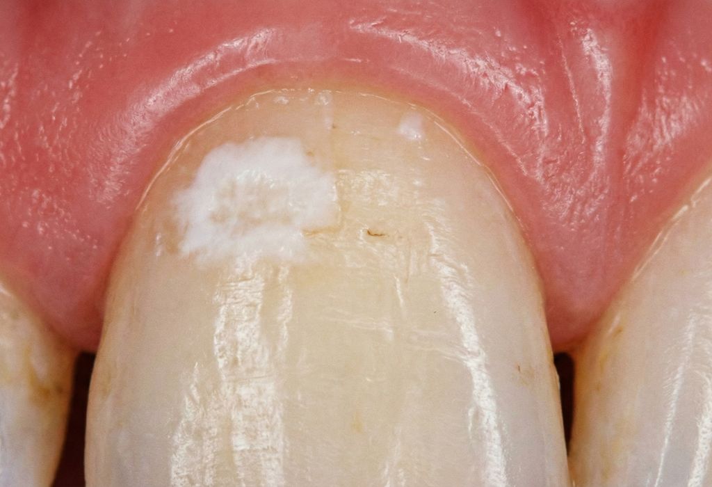 Manchas blancas en los dientes al quitar brackets