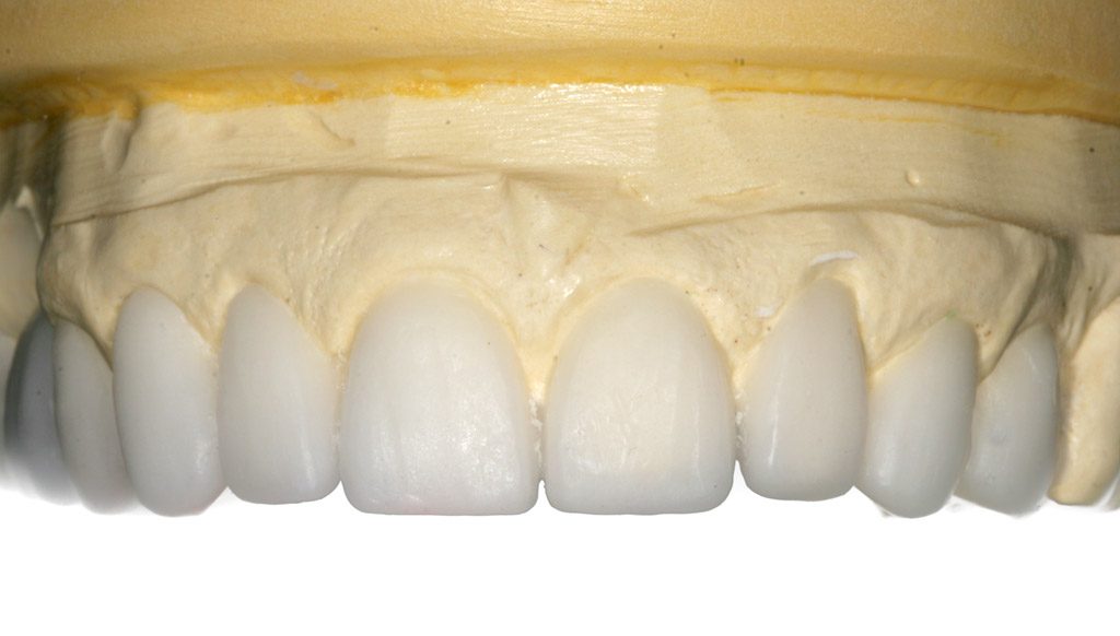 Carillas dentales sin rebajar el diente en Santa Coloma de Gramenet