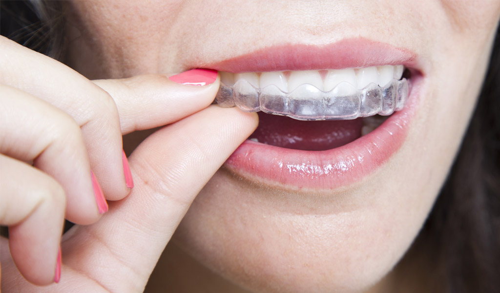 Ortodoncia Invisalign en Santa Coloma de Gramenet