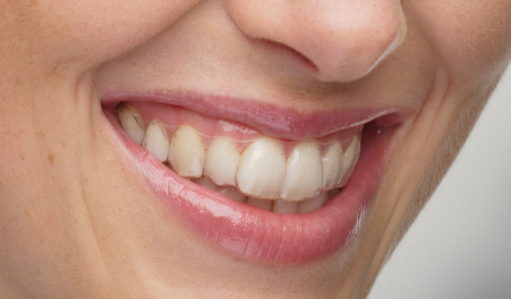 Ortodoncia Invisalign en Santa Coloma de Gramenet
