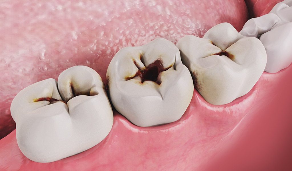 Prevención de caries en Santa Coloma de Gramenet