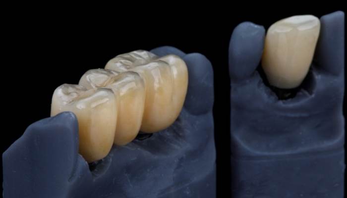 puente dental ventajas
