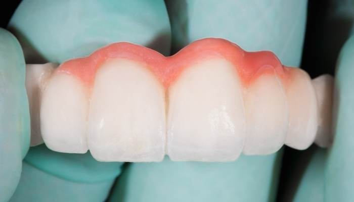 puente dental
